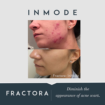 Fractora. Diminish the appearance of acne scars.